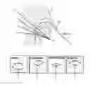 Fig. 01 - OPTICAL SENSOR FOR A CATHETER