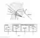 Fig. 03 - OPTICAL SENSOR FOR A CATHETER