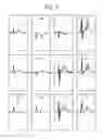 Fig. 10 - Estimating distribution fluctuation and/or movement of electrical activity through a heart tissue