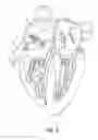 Fig. 04 - Dual multiray electrode catheter