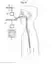 Fig. 11 - Methods and apparatus for guiding medical care based on detected gastric function