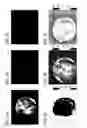 Fig. 07 - Systems and methods for diagnosis of middle ear conditions and detection of analytes in the tympanic membrane
