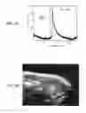 Fig. 06 - HIGH INTENSITY FOCUSED ULTRASOUND AND METHODS OF PERFORMING NON-INVASIVE BIOPSIES USING SAME