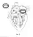 Fig. 06 - CONVERTIBLE BASKET CATHETER