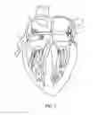 Fig. 08 - CONVERTIBLE BASKET CATHETER