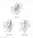 Fig. 28 - Knotless suture anchor and methods of use