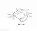 Fig. 49 - Knotless suture anchor and methods of use
