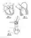 Fig. 02 - Systems for deploying knotless suture anchoring clamps