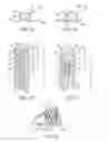 Fig. 05 - Device and method for establishing an artificial arterio-venous fistula
