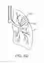 Fig. 07 - Methods and devices for passive residual lung volume reduction and functional lung volume expansion