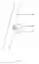 Fig. 22 - Polymeric electrospun embolization device and methods of use