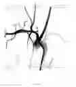 Fig. 31 - Polymeric electrospun embolization device and methods of use