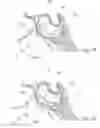 Fig. 35 - DEVICES, SYSTEMS AND METHODS FOR DIAGNOSING AND TREATING SINUSITIS AND OTHER DISORDERS OF THE EARS, NOSE AND/OR THROAT