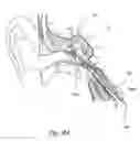 Fig. 40 - DEVICES, SYSTEMS AND METHODS FOR DIAGNOSING AND TREATING SINUSITIS AND OTHER DISORDERS OF THE EARS, NOSE AND/OR THROAT