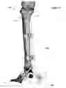 Fig. 48 - Clamping device for use with an anatomic external fixation device