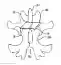 Fig. 01 - Interspinous stabilization implant