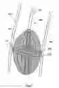 Fig. 07 - Devices, systems, and methods for valve removal
