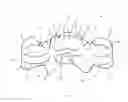 Fig. 05 - Oral appliance, system and method for correcting class III problems of mandibular prognathism
