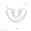 Fig. 09 - Oral appliance, system and method for correcting class III problems of mandibular prognathism