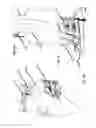Fig. 17 - Dental implant for bone collection and distribution