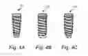 Fig. 06 - Dental implant
