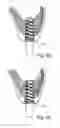 Fig. 12 - Dental implant