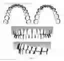 Fig. 04 - Method for creating flexible arch model of teeth for use in restorative dentistry