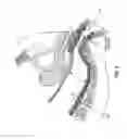 Fig. 05 - METHOD AND APPARATUS FOR ENDOSCOPICALLY TREATING RECTAL PROLAPSE