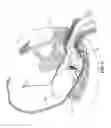 Fig. 09 - METHOD AND APPARATUS FOR ENDOSCOPICALLY TREATING RECTAL PROLAPSE