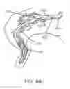 Fig. 28 - Peripheral arterialization devices and methods of using the same
