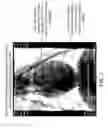 Fig. 08 - Devices and methods for effectuating percutaneous Glenn and Fontan procedures
