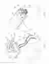 Fig. 04 - TRANSOSSEOUS SUTURE CONSTRUCTS