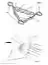 Fig. 06 - Double accommodating intraocular accordion lens