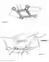 Fig. 11 - Double accommodating intraocular accordion lens