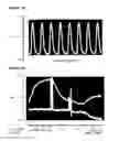 Fig. 05 - Pouch-like construct for preventing heart distension