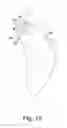 Fig. 05 - Glenoid defect-filling component