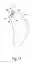 Fig. 06 - Glenoid defect-filling component