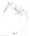 Fig. 07 - Glenoid defect-filling component