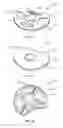 Fig. 27 - Spinal implant system and method