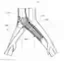 Fig. 01 - Variable radial stiffness and variable diameter intraluminal device