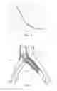 Fig. 05 - Variable radial stiffness and variable diameter intraluminal device