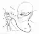 Fig. 01 - Methods and apparatuses for treatment of meibomian gland dysfunction