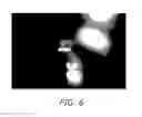 Fig. 06 - Intracameral sustained release therapeutic agent implants