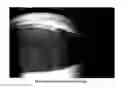 Fig. 01 - Microsphere Drug Delivery System for Sustained Intraocular Release