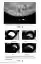 Fig. 04 - Microsphere Drug Delivery System for Sustained Intraocular Release
