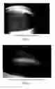 Fig. 05 - Microsphere Drug Delivery System for Sustained Intraocular Release