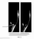 Fig. 06 - Microsphere Drug Delivery System for Sustained Intraocular Release