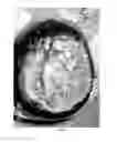 Fig. 06 - Pharmaceutical compositions for treating thermal injuries and wounds combined with bone injuries
