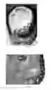 Fig. 07 - Pharmaceutical compositions for treating thermal injuries and wounds combined with bone injuries
