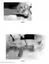 Fig. 02 - Pharmaceutical compositions for treating thermal injuries and wounds combined with bone injuries